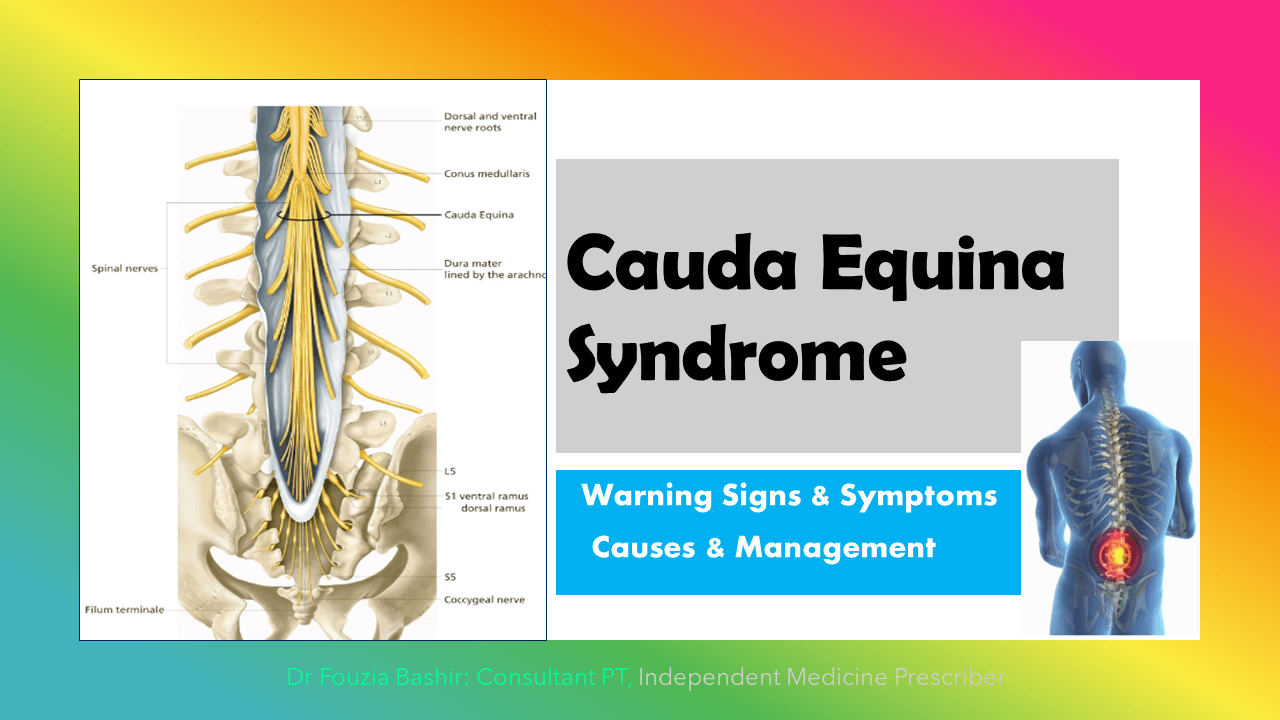 The Cauda Equina Syndrome:  Causes, Sign & Symptoms, Diagnosis, Treatment And Prognosis